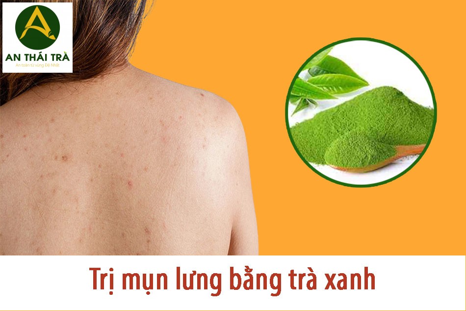 Cách trị mụn lưng bằng là trà xanh